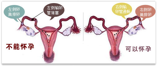 输卵管堵塞的症状