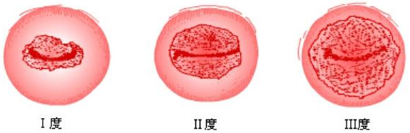 在运城哪个医院治疗宫颈糜烂好