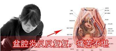 运城盆腔炎怎么治