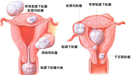 运城子宫肌瘤的危害