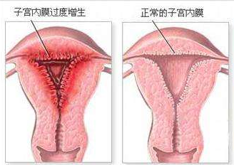 子宫不停的出血，用什么来拯救你的健康